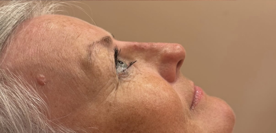 Rhinoplasty after treatment